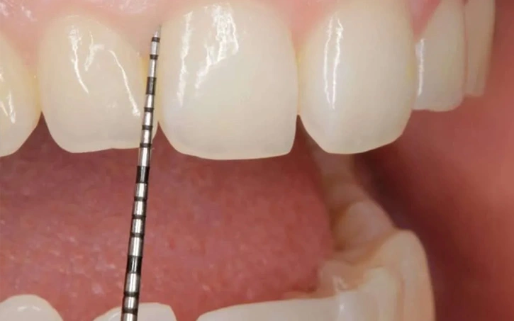 Dentist performing scaling and root planing during a periodontics treatment visit